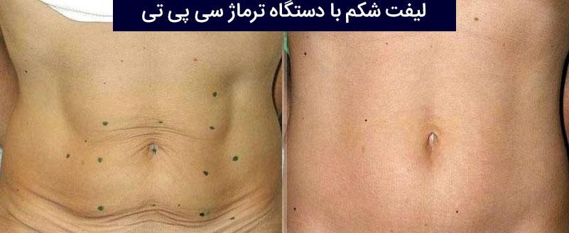 نکات مهم جهت انجام ترماژ ( Thermage )