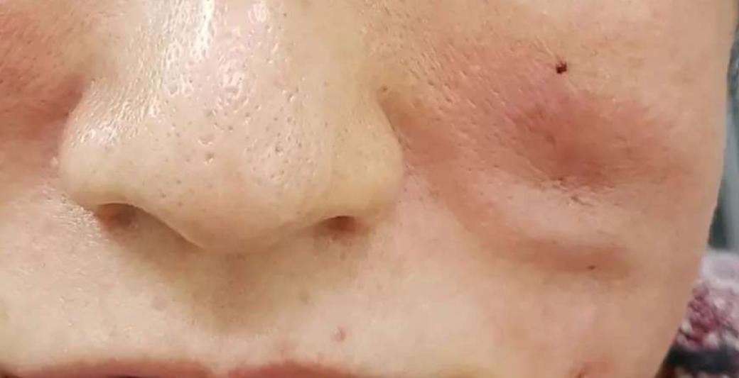 در چه شرایطی با عوارض لیفت نخ مواجه هستیم ؟ در چه شرایطی با عوارض لیفت نخ مواجه هستیم ؟