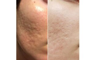 کدام لیزر برای بهبود منافذ باز و کشسانی پوست مناسب است ؟