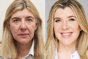 لیفت صورت یا بوتاکس