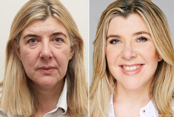 لیفت صورت یا بوتاکس