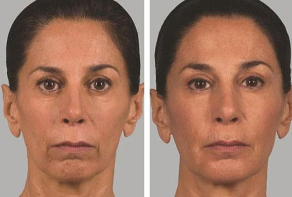 ژل اسکالپترا (Sculptra) چیست ؟
