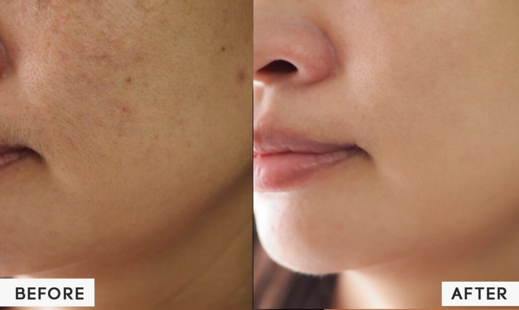 تاثیر لیزر برای بهبود منافذ پوست تاثیر لیزر برای بهبود منافذ پوست