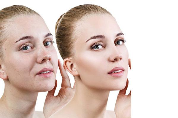 معرفی لیفت صورت معرفی لیفت صورت