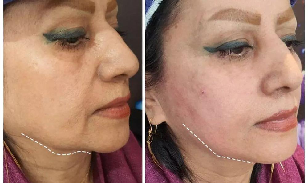 درسا کلینیک بهترین مرکز جهت انجام لیفت صورت درسا کلینیک بهترین مرکز جهت انجام لیفت صورت