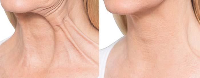 بررسی دوره نقاهت لیفت گردن