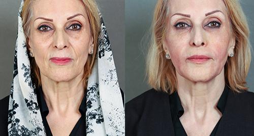 آیا طبیعی شدن نتیجه لیفت صورت به پزشک وابسته است ؟ آیا طبیعی شدن نتیجه لیفت صورت به پزشک وابسته است ؟