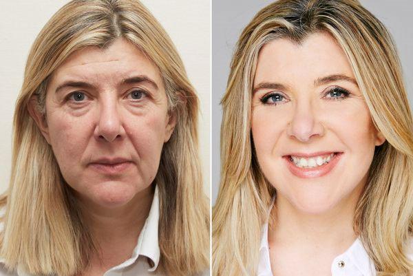 آیا نتیجه لیفت صورت طبیعی است ؟ آیا نتیجه لیفت صورت طبیعی است ؟