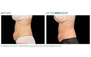 آیا ام اسکالپت بی خطر است ؟