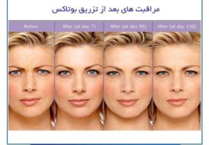 بعد از بوتاکس چه کارهایی می توان انجام داد ؟