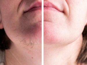 علت برگشت موهای زائد بعد از لیزر چیست ؟