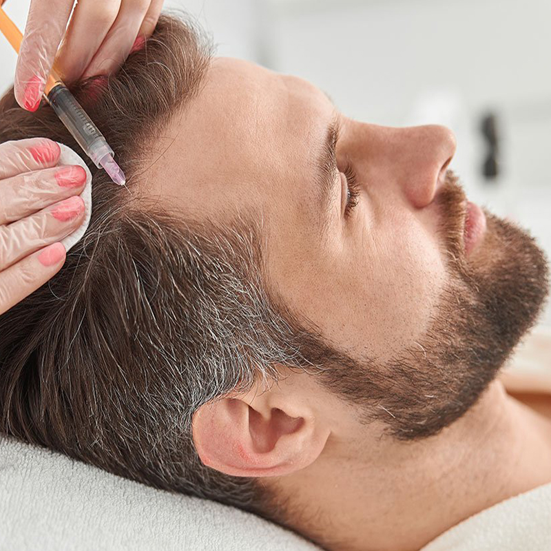 تاثیر مزوتراپی در درمان ریزش مو