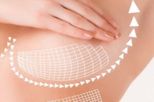 عمل لیفت سینه وهرآنچه که در مورد آن باید بدانید