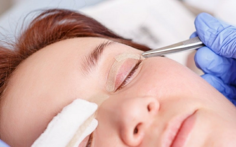 لیزر درمانی برای پلک