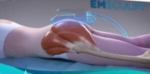 آیا نتایج ام اسکالپت دائمی است ؟