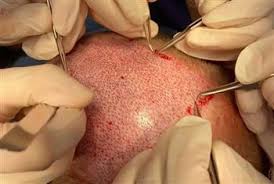 چه زمانی می توان در مورد کاشت مو ناموفق صحبت کرد؟