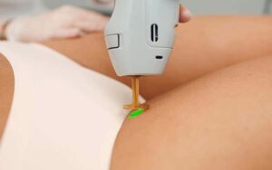 عوارض لیزر بیکینی برای دختر چیست؟