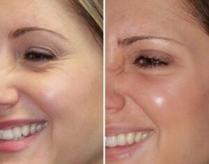 آیا هایفوتراپی چشم درد دارد؟