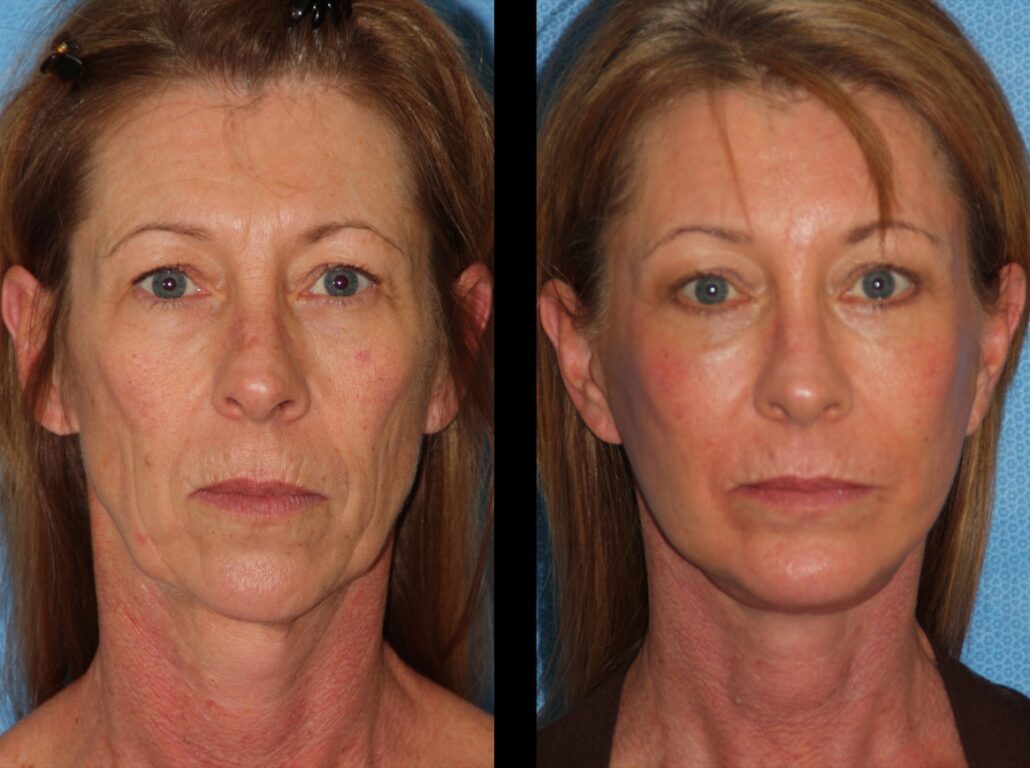 راه حل هایی برای کاهش ورم صورت که باید بدانید!