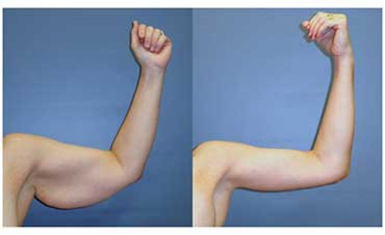 نحوه مراقبت بعد از براکیوپلاستی