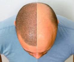 آیا امکان دارد موهای کاشته شده رشد نکنند؟