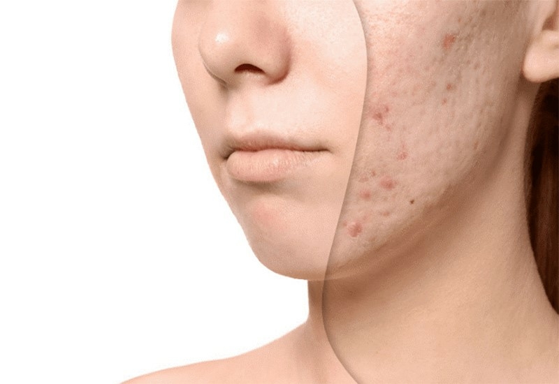 آیا بعد از تزریق برروی صورت ما توده به وجود می آید؟