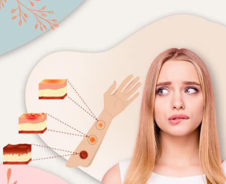 عوارض لیزر موهای زائد