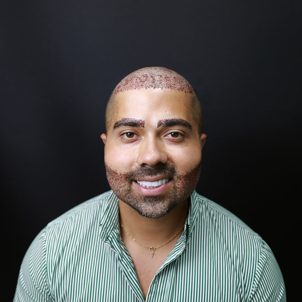 آیا ورم بعد از کاشت مو طبیعی است؟