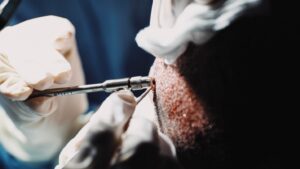 چگونه موهای کاشته شده را تقویت کنیم؟