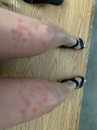 تاثیر برنزه شدن قبل از لیزر در ایجاد عوارض