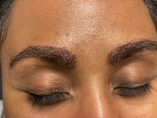 علت ورم و کبودی چشم بعد از کاشت ابرو چیست؟