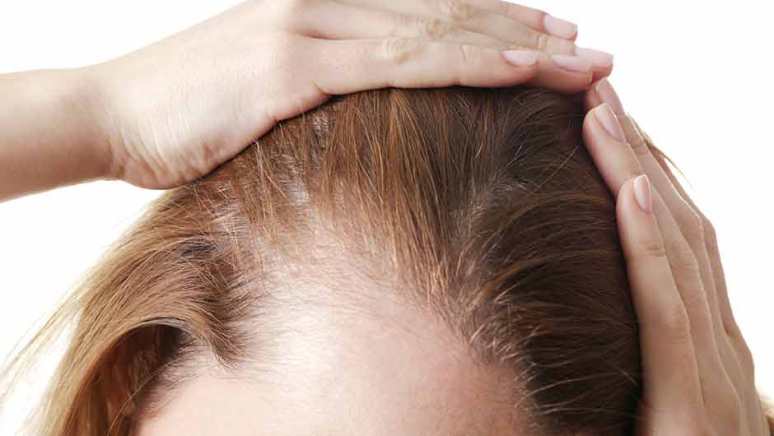 روش های درمان نازک شدن مو در طب سنتی
