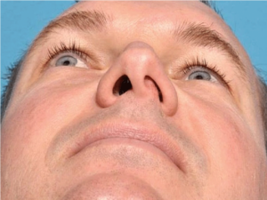 علائم انحراف بینی و راه های درمان آن