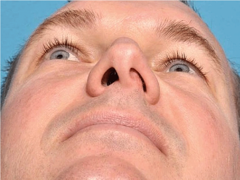 علائم انحراف بینی و راه های درمان آن