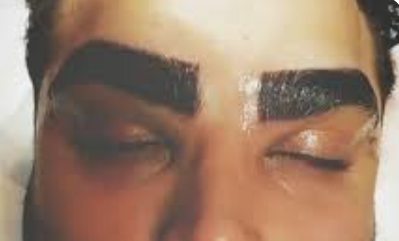 دوران نقاهت برای کاشت ابرو