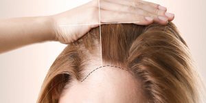 بررسی شرایط پزشکی کاشت مو در بانوان
