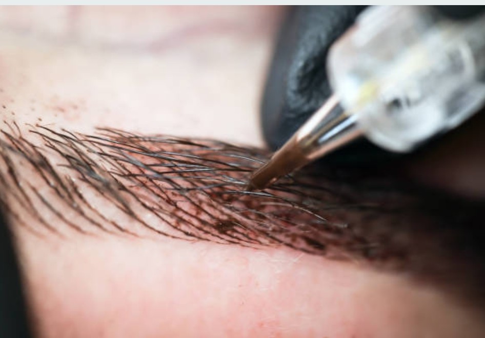 کاشت ابرو به روش FUT (Follicular Unit Transplantation):