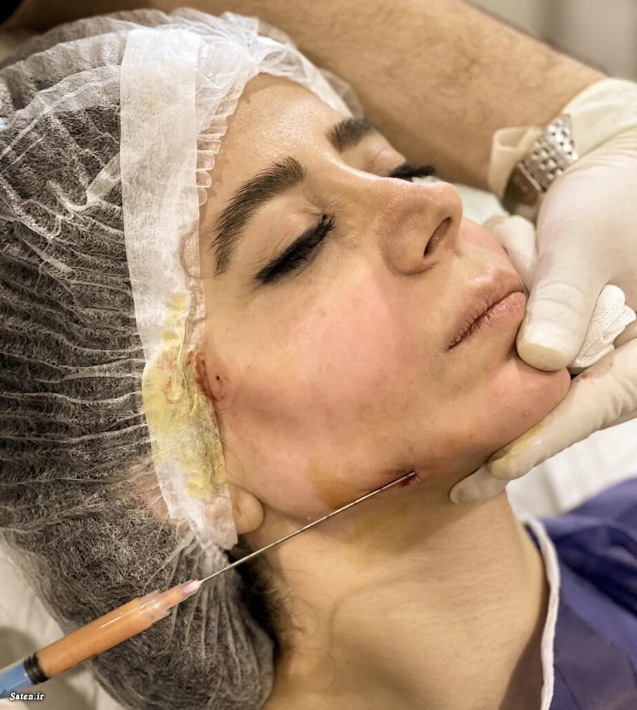 تزریق چربی تزریق چربی