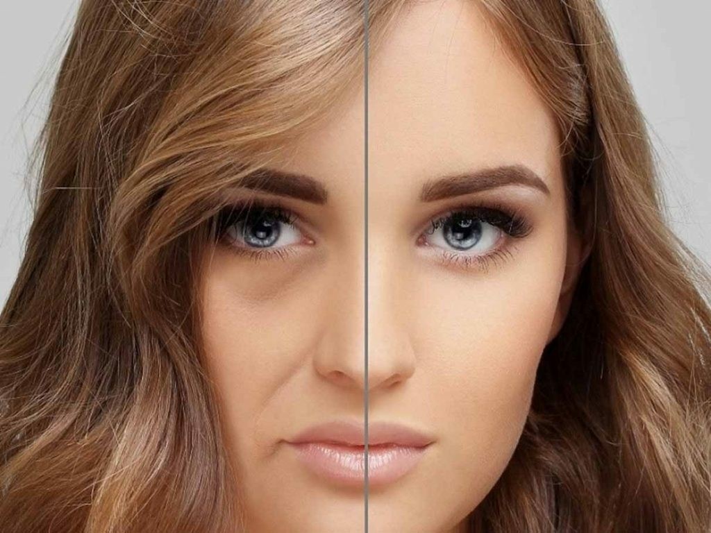 تزریق چربی به صورت چقدر ماندگاری دارد؟