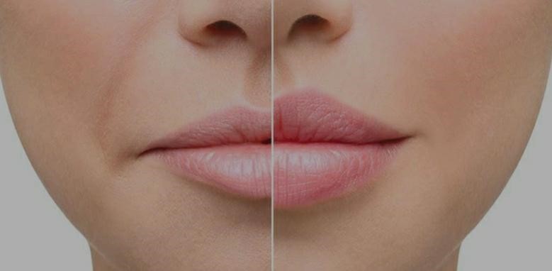 روند تزریق چربی به لب های مراجعه کننده!