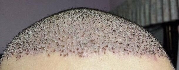 روش شستشو مو بعد از کاشت مو