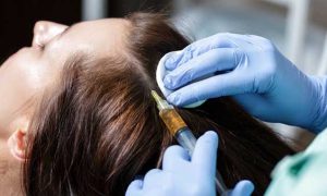 مزوتراپی مو از چه سنی مناسب است؟