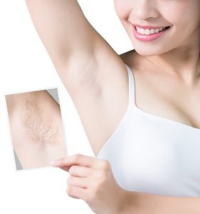 آیا لیزر موهای زائد باعث سرطان می شود؟