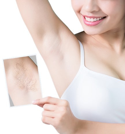 آیا لیزر موهای زائد باعث سرطان می شود؟