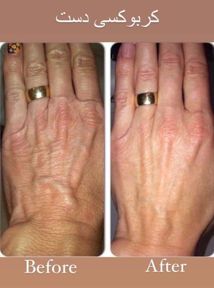 استفاده از کربوکسی تراپی جهت جوانسازی پوست