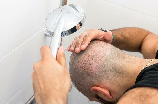 مناسب ترین زمانی که شما می توانید، بعد از کاشت مو به حمام بروید!