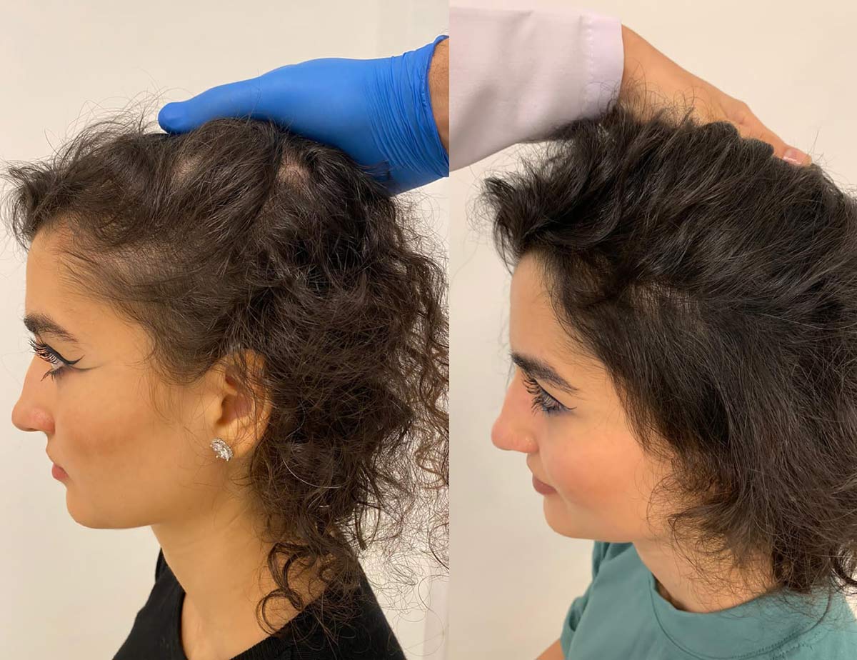 راه‌های موثر برای رفع درد مزوتراپی مو پس از انجام