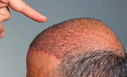 مراحل شستشوی کف سر بعد از پیوند مو