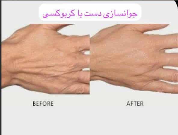 نکات مهم هنگام استفاده از کربوکسی تراپی جهت جوانسازی پوست دست
