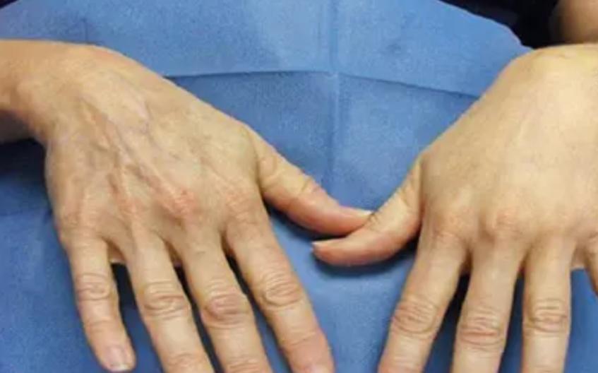 مزایایی جوانسازی پوست با کربوکسی تراپی